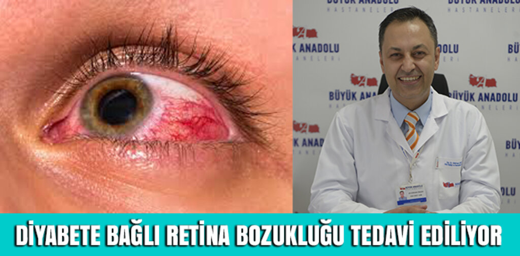 DİYABETE BAĞLI RETİNA BOZUKLUĞU TEDAVİ EDİLİYOR
