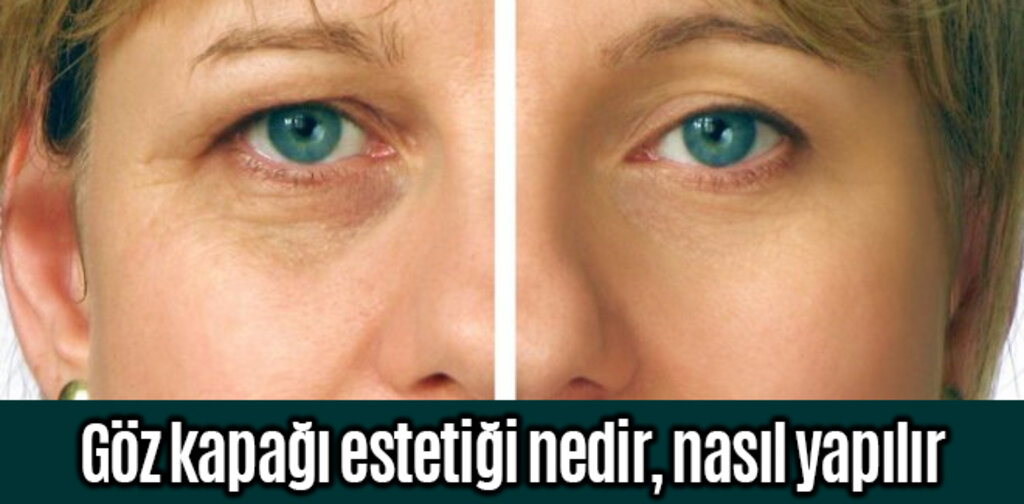 Göz kapağı estetiği nedir, nasıl yapılır?