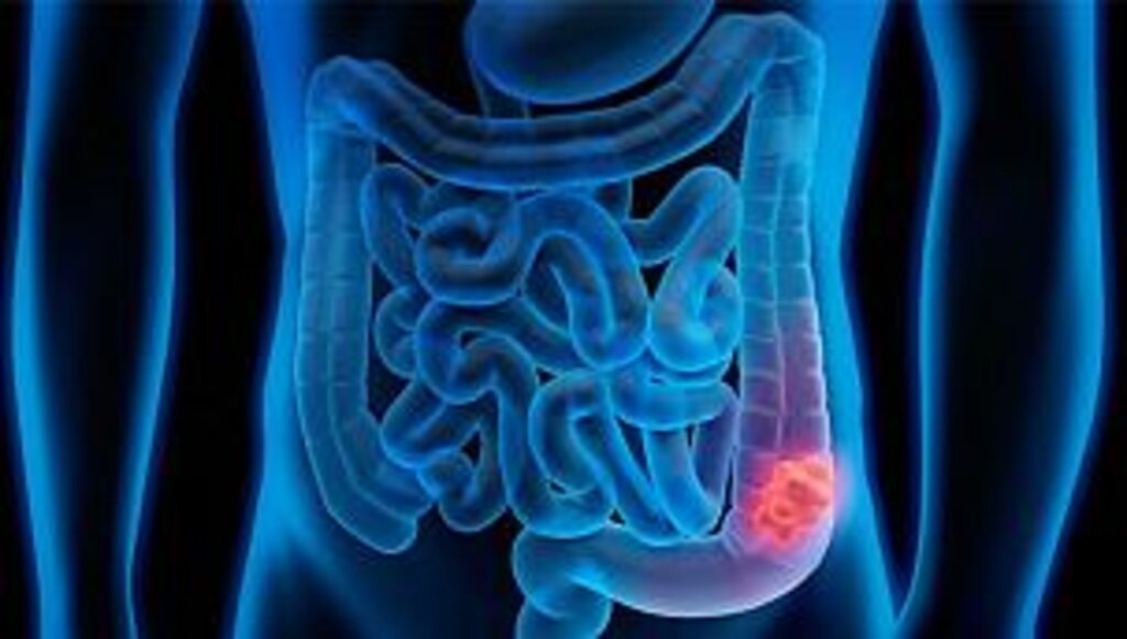Kalın bağırsak kanserinin belirtileri nelerdir?